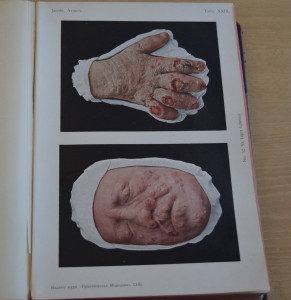 Dr.E.Jacobi Атласъ болъзней кожи. С.-Петербургъ. 1910 г.