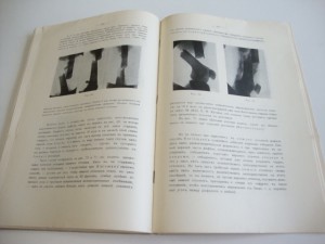 1914г. К.Ф.Вегнер. Закрытые переломы. Харьков